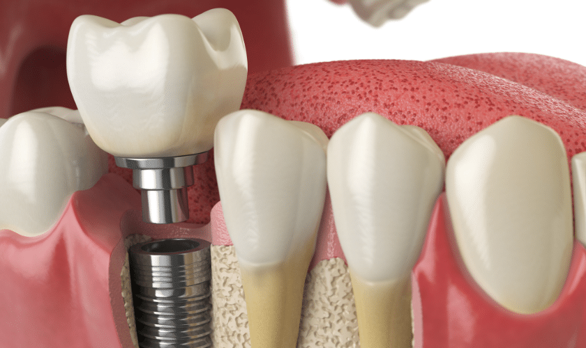 The Wonder of Dental Implants