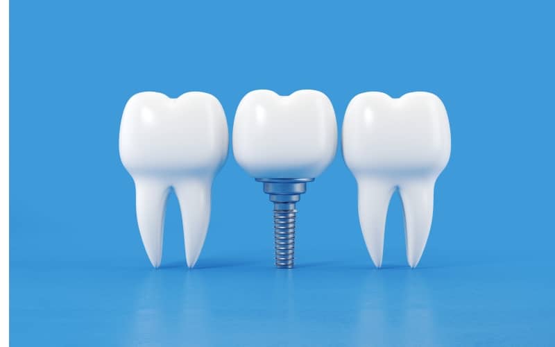 life-changing impact of dental implants